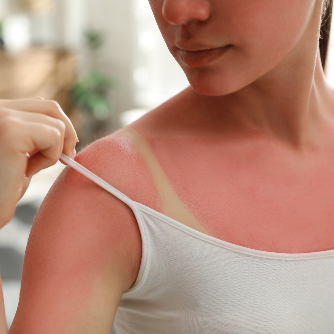 Vitamin C for Sunburn Prevention: Why Sunscreen Alone Isn't Enough